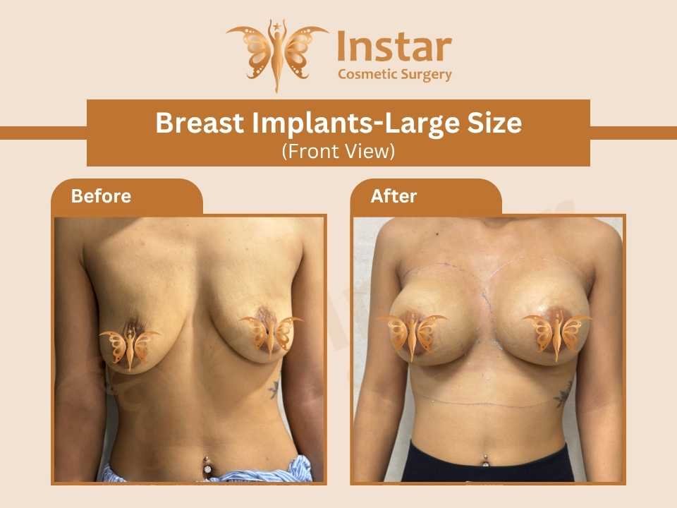 Breast-Implants-Large-Size-Front View